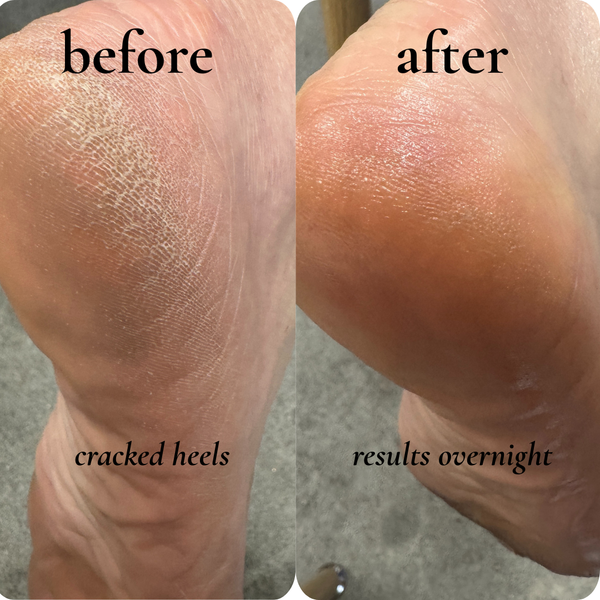 cracked heels