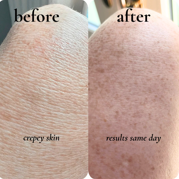 crepey skin