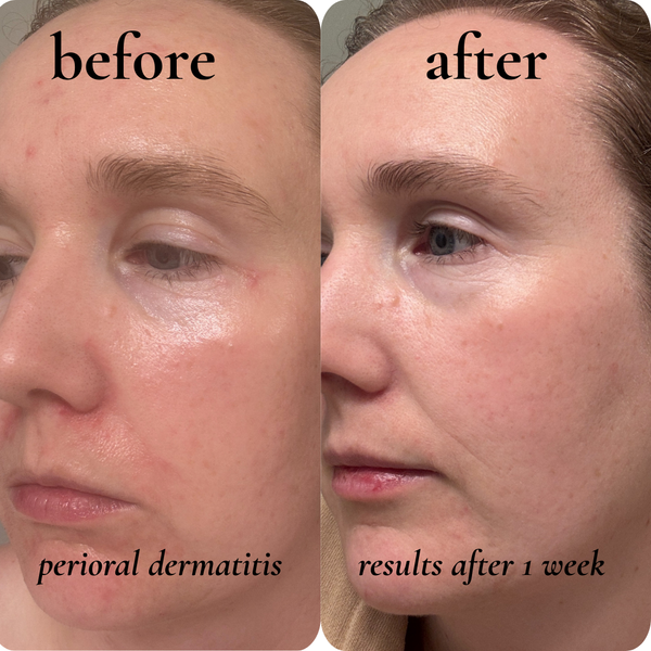 perioral dermatitis
