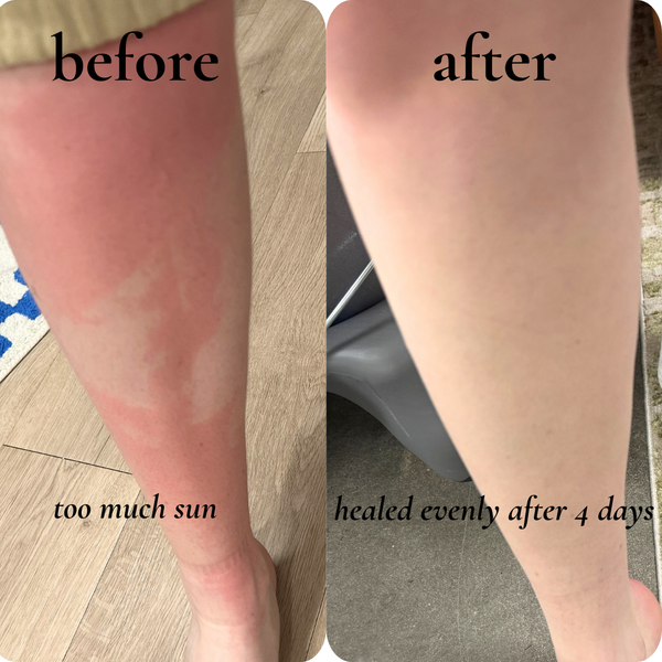 sun damage + burns