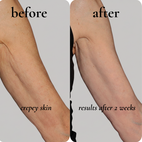 crepey skin