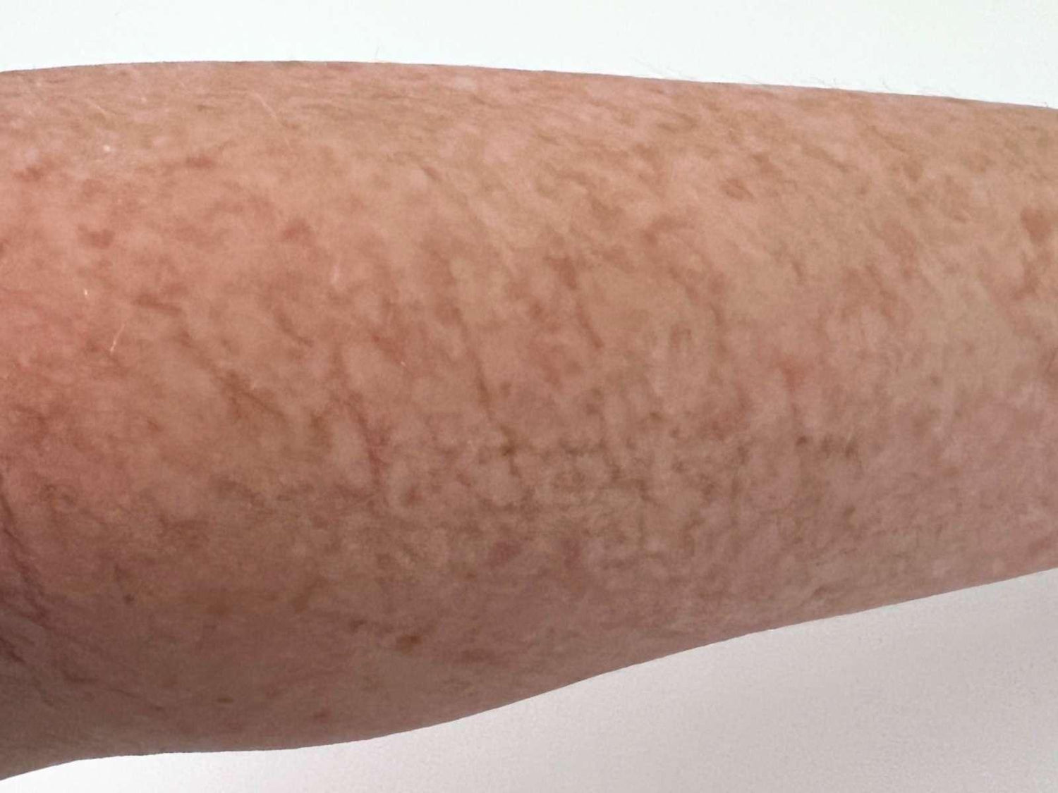 an actual hellomellow customer age 55 crepey arm skin  day 90